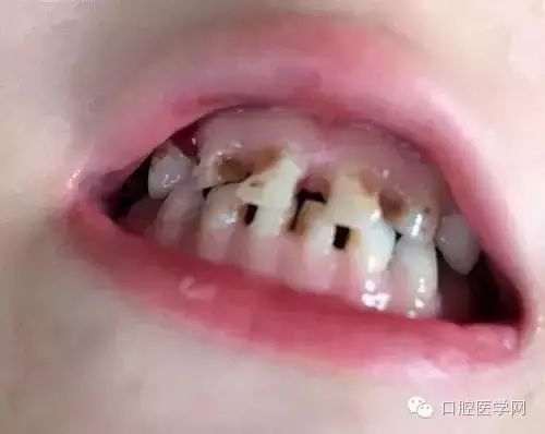 补牙后为什麼还牙疼呢？