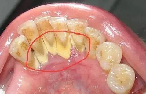 牙齿缝里，抠出黄色物质到底是什麼？为啥那麼臭