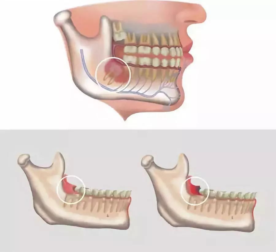 智齿一定要拔吗？关於智齿的真相看这里！